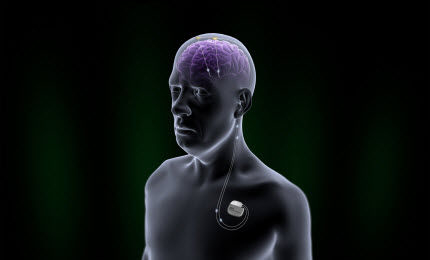implantable-neurostimulator