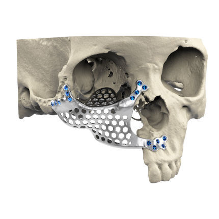 Custom Made Periorbital Implant Craniotech