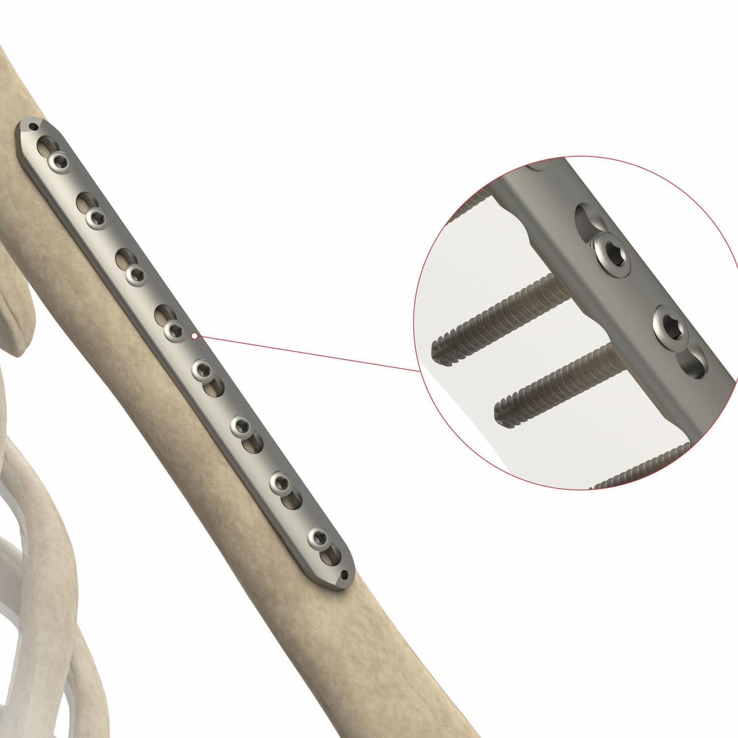 Radius Compression Plate As St Ases Orthopedics Mid Shaft