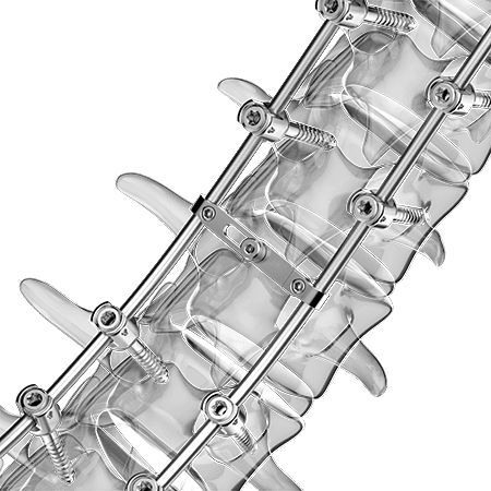 Thoraco Lumbar Osteosynthesis Unit Aplus Biotechnology Posterior