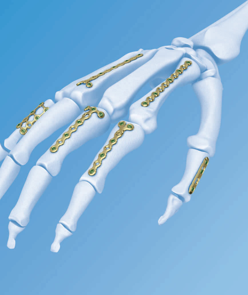 Metacarpus Compression Plate LCP Depuy Synthes