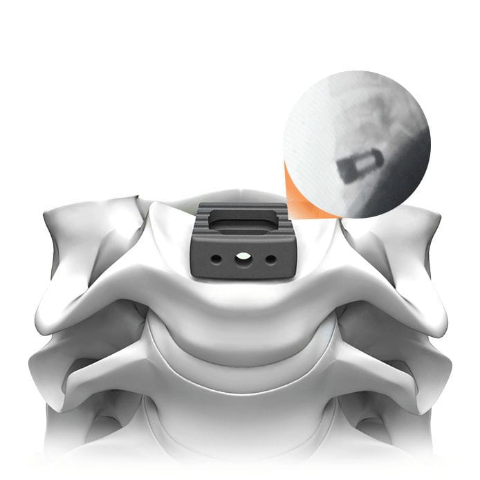 Cervical Interbody Fusion Cage Plateau C Ti Life Spine Anterior