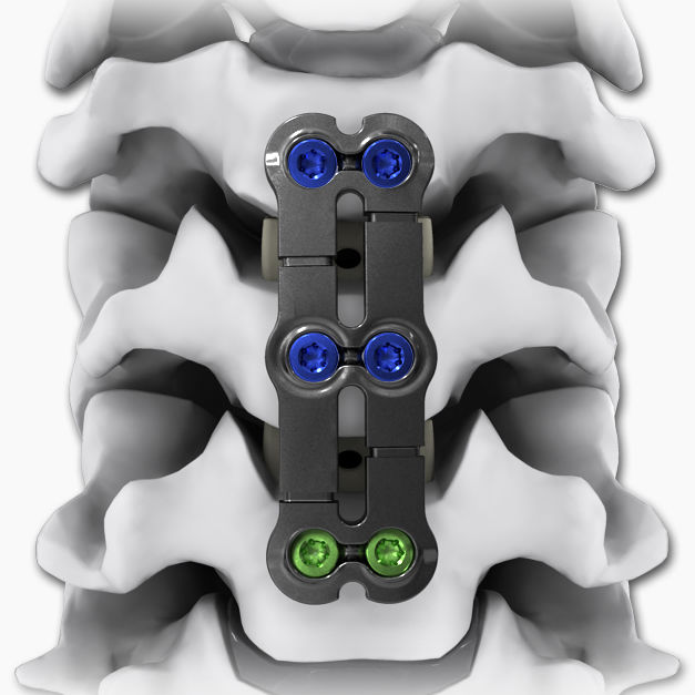 Cervical Arthrodesis Plate Kinetic Sl Life Spine Locking