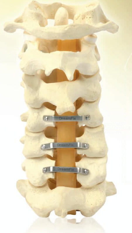 Spinal Fixation