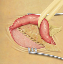 implantable mesh prosthesis for inguinal hernias (laparoscopic surgery) BIODESIGN&reg; COOK Medical
