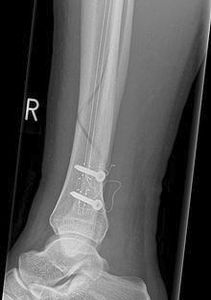 tibia intramedullary nail / medial / distal / proximal