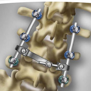 lumbo-sacral spinal osteosynthesis unit / posterior / adult