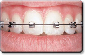 self-ligating orthodontic bracket / mini