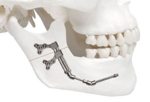 mandibular distractor / internal