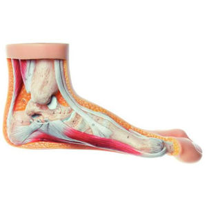 foot model / pathological
