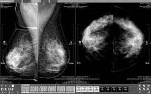 diagnostic software / analysis / for mammography
