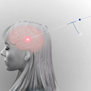 brain tumor treatment laser ablation system / MRI-guided