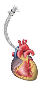 venous cannula / aortic / pediatric