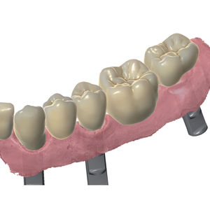 CAM software / CAD / for dental prosthesis design / dental laboratory