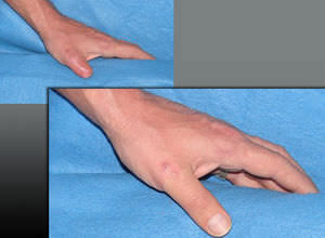 finger cosmetic prosthesis / adult