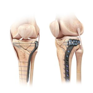 tibia compression plate / proximal