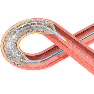 coronary stent / cobalt-chromium / drug eluting
