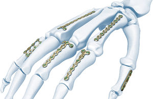 metacarpus compression plate