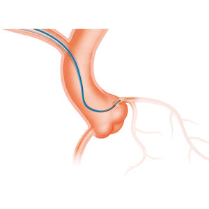 PTCA catheter / guiding / coronary