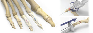interphalangeal foot joint arthrodesis compression bone screw / cannulated