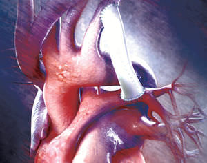 aortic vascular prosthesis / straight / pediatric