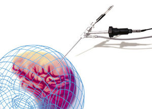 neuroendoscope / bent