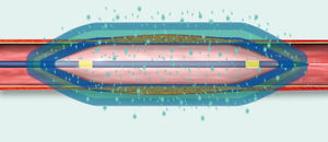 dilatation catheter / PTA / central venous / balloon