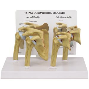 shoulder model / joint / pathological