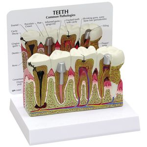 tooth model / pathological