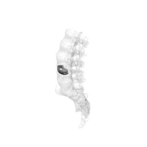 lumbar interbody fusion cage / transforaminal