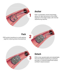 occlusion catheter / peripheral