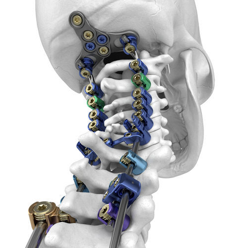 Occipito Cervico Thoracic Osteosynthesis Unit Northstar Seaspine