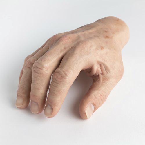 Hand Cosmetic Prosthesis Schubert And Braun Prothesenwerk Adult