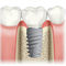 Conical Dental Implant NobelActive Nobel Biocare Services AG