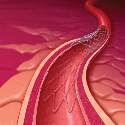 Stent Coron Rio Novelty Usm Healthcare Medical Devices Factory Em