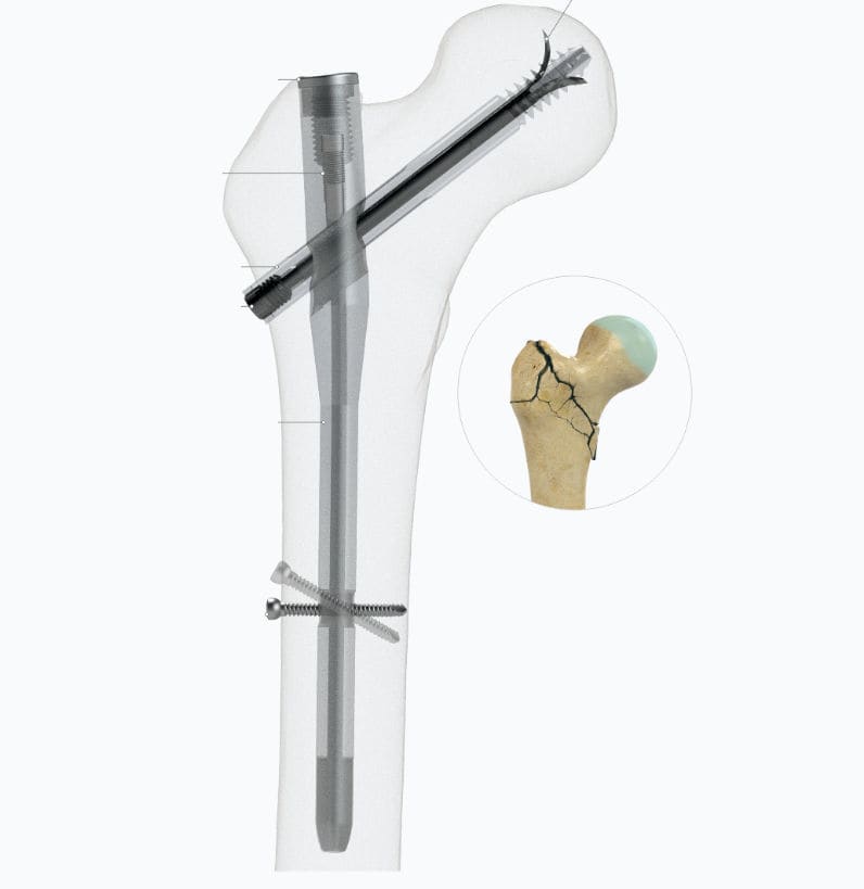 Haste Intramedular Para F Mur Zimed Medical Fixa O Proximal Para