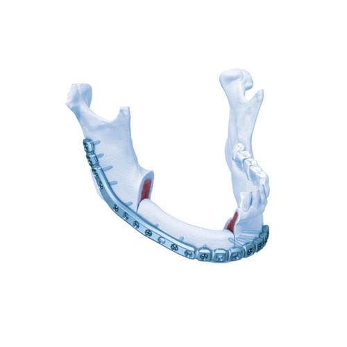 Placa De Compress O Ssea Para Mand Bula Matrixmandible Depuy