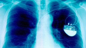 implantable-cardiac-stimulator