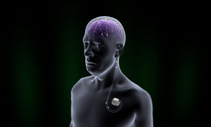 implantable-neurostimulator