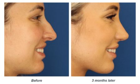 Ultrasonic Rhinoplasty: Revolutionizing Nasal Reshaping with Precision and Safety
