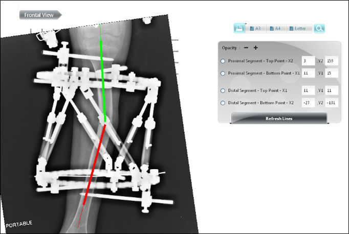 Modular External Fixation System - Smart Correction® - Response Ortho ...