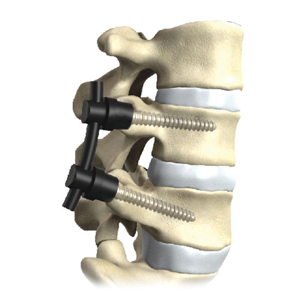 Thoraco-lumbo-sacral osteosynthesis unit - CarboClear™ - CarboFix
