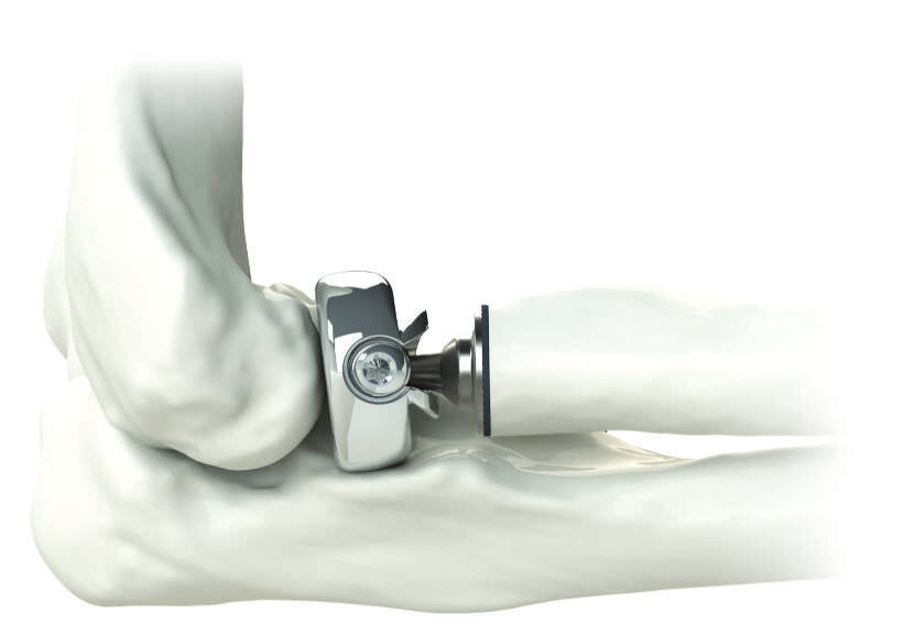 Radial head prosthesis - ALIGN ® - Skeletal Dynamics