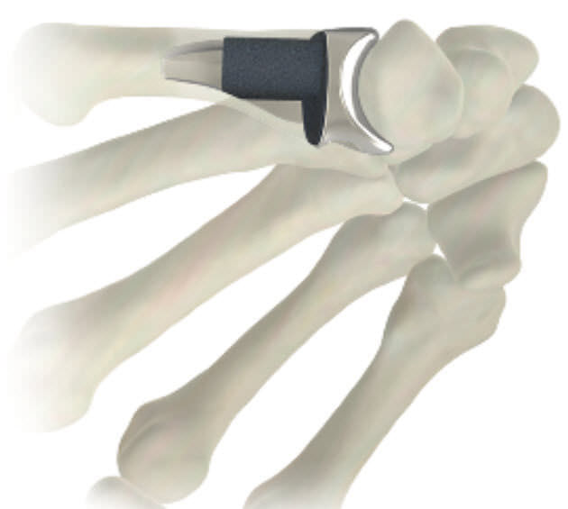 Metacarpophalangeal joint implant STABLYX ® Skeletal Dynamics