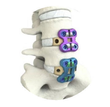 Lumbar arthrodesis plate - ALIF - NuVasive - metallic / 1 level