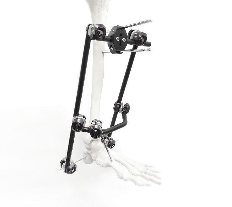 Tibia external fixation system - Variis - Fixus - ankle / tubular / adult