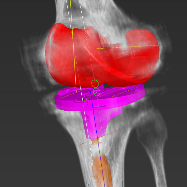 Orthopedic software - mediCAD Hectec GmbH - planning / knee / 3D