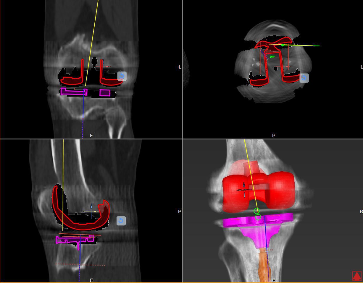 Orthopedic software - mediCAD Hectec GmbH - planning / knee / 3D