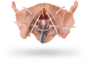 Pelvic Floor Reconstruction Reconstruction Mesh Vaginal Approach