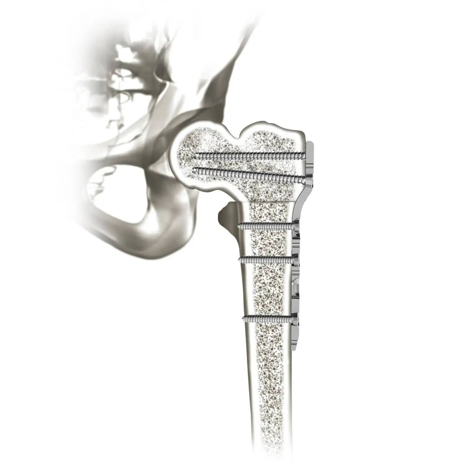Femur compression plate - 00-0907-0103 - OrthoPediatrics - proximal /  locking / metallic